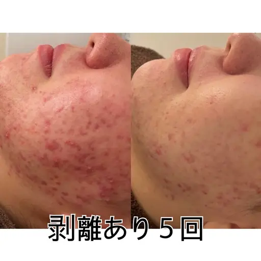 【毛穴/ニキビケア】お顔ハーブピーリング（剥離あり）