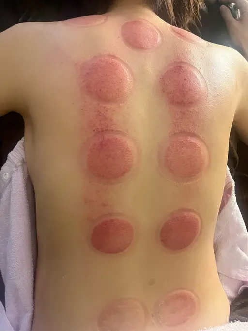 【疲れ・デトックス・体のダルさ】全身カッピング+揉みほぐし