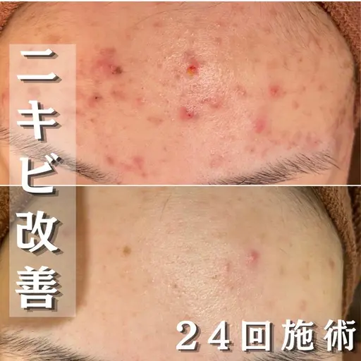 【🩷8/22-23限定クーポン🩷】ダウンタイム無しで確実に治す!脱ニキビ肌コース!ピーリング+W鎮静パック