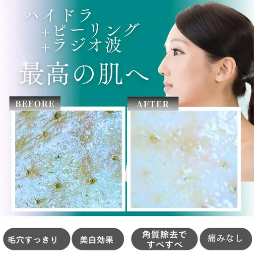 🍫🌸4月限定バレンタイン肌ケアキャンペーン💧水流ハイドラ〈全顔)&🫧角質ピーリング💎+ラジオ波で毛穴ケア🔥