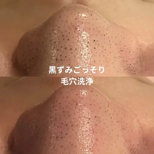 🫧残り15名様限定🫧毛穴洗浄(ピーリング込み)|黒ずみ・角栓ごっそりケア(通常5,500円が2,200円に)