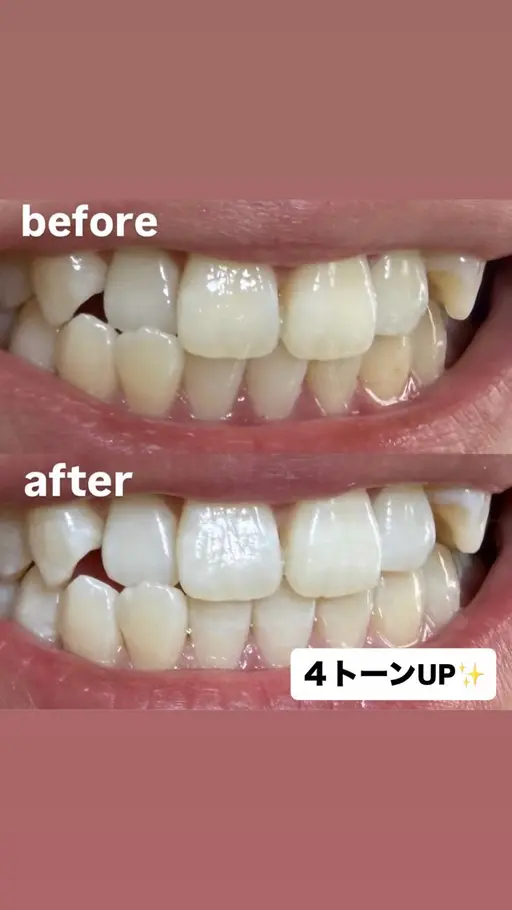 セルフホワイトニング【モニター様募集】🦷✨✨