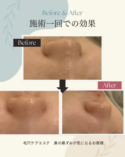 【ミニモ限定】毛穴黒ずみ洗浄✨ザラつきつるんケア