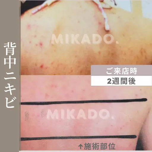 【ブライダルに】ハーブピーリングで背中のニキビケアに90分¥38500→¥30800