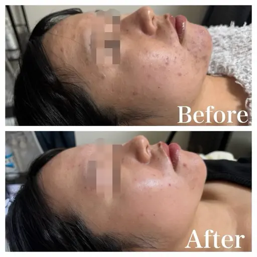針入り次世代ハーブピーリング🌿＋高級美顔器セルキュア使用✨毛穴洗浄｜ツルスベ肌へ【毛穴/いちご鼻/ニキビ】