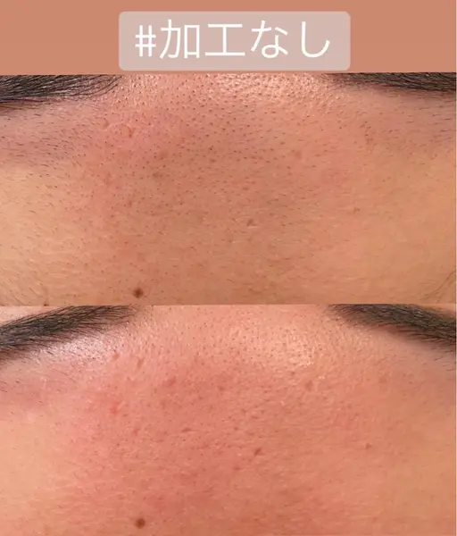おでこのワックス脱毛
