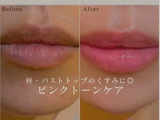 NEW【唇・バストトップをピンクに】話題のピンクトーンケア体験🎀💗1部位¥5000