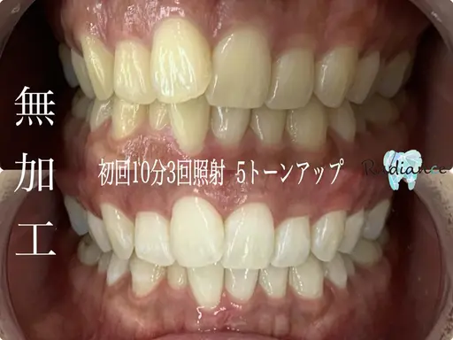 【初回のみ】1日完結☆セルフホワイトニング15分2回照射☆本数無制限