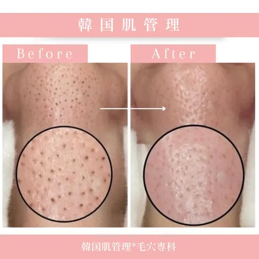 韓国肌管理【ハイドラ毛穴洗浄】【美容液導入】憧れの水光肌へ〜🫧