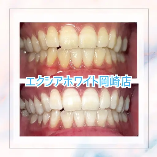 【minimo限定】セルフホワイトニング(3照射)¥2,000円