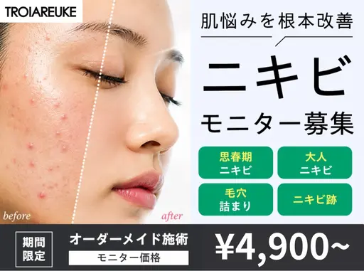 【期間限定モニター募集】ニキビでお悩みの方