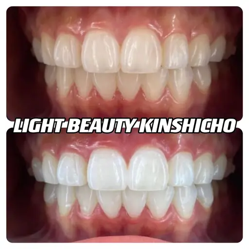 【オススメ】1日集中 20分×2照射 黄色く着色汚れのある歯を綺麗で自然な白さへ🦷✨