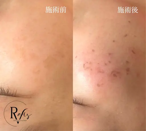 【シミ取り放題‼️✨️】肌に負担がかからず、痛みゼロ！気になるシミをどんどん排出🔥若見え肌🤍腕もok🎶