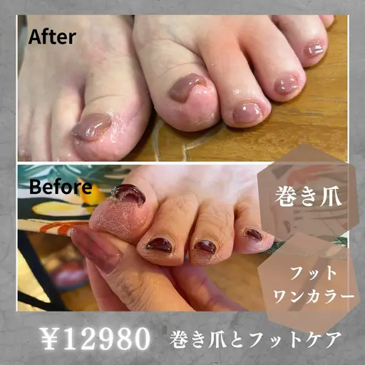 【巻き爪ケア×美爪✨】お悩み解決しながらフットネイル。プロの技術で歩くのも楽しく！ワンカラー10本込◎次回予約でお得に