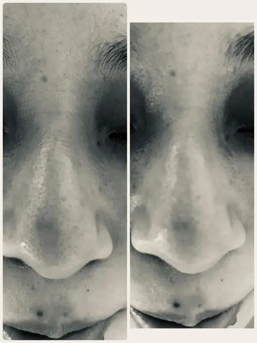 ブツブツ毛穴👃コース★黒ずみ毛穴★たるみ毛穴★開き毛穴★皮脂毛穴