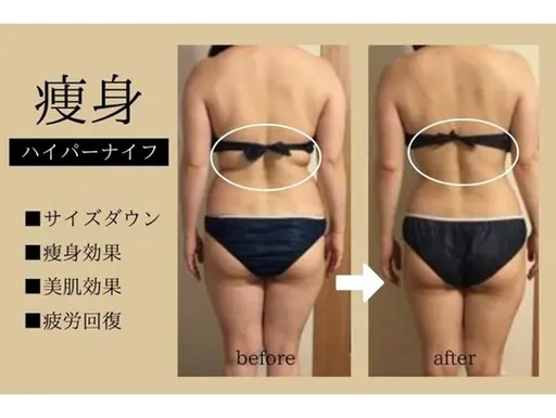 《美脚微尻集中》ハイパーナイフ+リンパマッサージ60分¥9000→¥3500