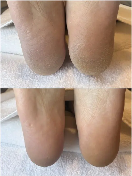 足裏角質ケア50分