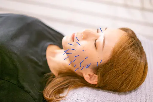 美容鍼+筋膜フェイシャル(60分)今まで美容鍼でご満足できてこなかったた方へ♪《美顔鍼/美容鍼》