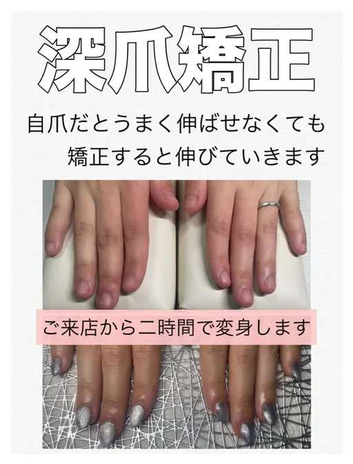 深爪矯正【長さ出し】◆カラーあり◆(オフ込)むしったり 割れたり 噛んで小さくなってしまった爪も美しく綺麗な状態に✧︎