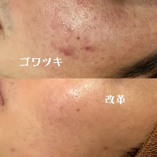 【メンズ限定メニュー🙆♂️✨】ニキビ・ニキビ跡・毛穴の肌トラブル改善をしてみませんか?✨ミニモ価格5480円❕❕