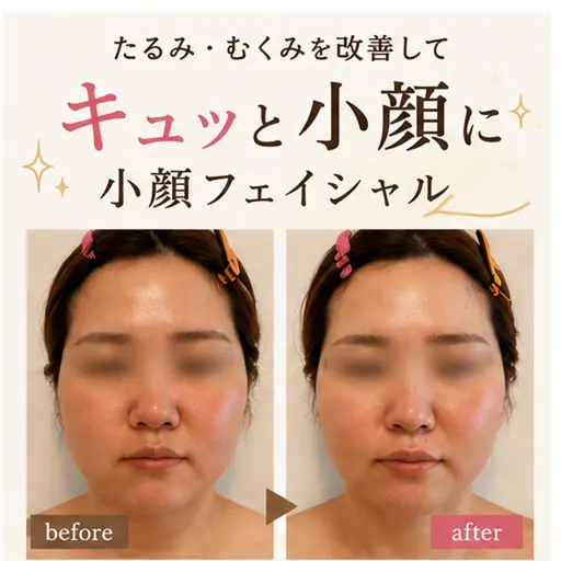 《ミニモ限定》45分*小顔&リフトupフェイシャルパック8,900円→5,900円