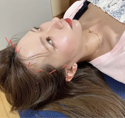 【むくみ&たるみ撃退🫧頭皮から上げる❤️🔥】 引き上げ強化頭皮鍼×本質ケア→ 首・肩・目の疲れも同時にケア