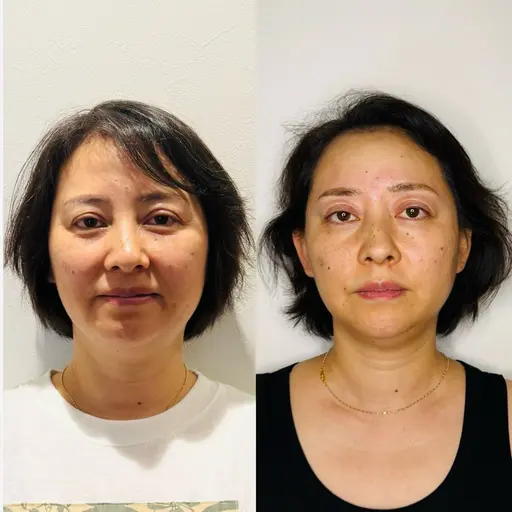 【レディース限定】効果実感率100%の大人気フェイシャル施術🌼ビューティーライザー🌼¥18000→¥10000