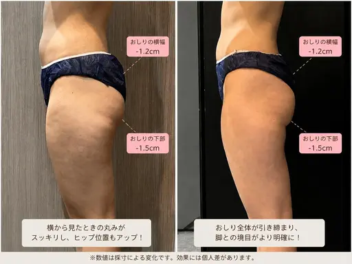 ✨【美脚・美尻】下半身集中痩身60分✨太もも・ふくらはぎ・ヒップを徹底ケアでシンデレラボディへ大変身✨¥3980