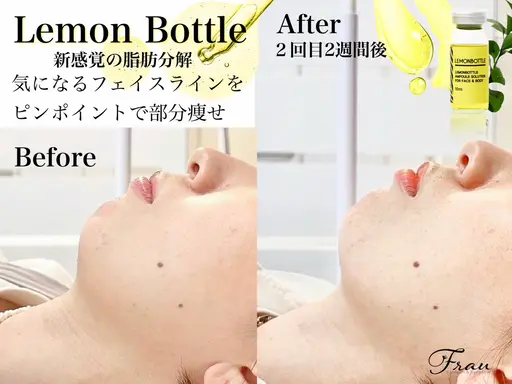 韓国発🇰🇷🍋美容液導入💆♀️🍋【地域最安】二重顎フェイスラインすっきり‼️