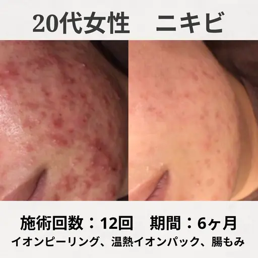 【🌿本日限定🌿】人気メニュー!とにかくニキビ跡をなんとかしたい‼️ピーリング+W鎮静パック