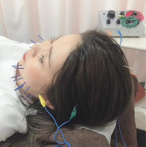✨ご好評につき9月も平日12時〜17時初回限定メニュー✨先着2名様✨美容鍼+鍼通電(パルス)+頭マッサージ✨