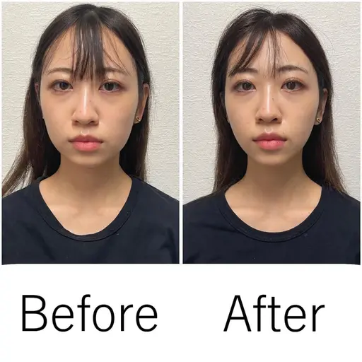 🎉おすすめNo.1🎉【むくみ・エラ・くいしばり特化メニュー】電気美容鍼+フェイスマッサージ+首肩背中マッサージ