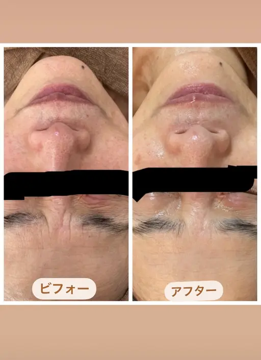 人気のメニュー ▪️ヒト幹細胞フェイシャルエステ(スペシャル)