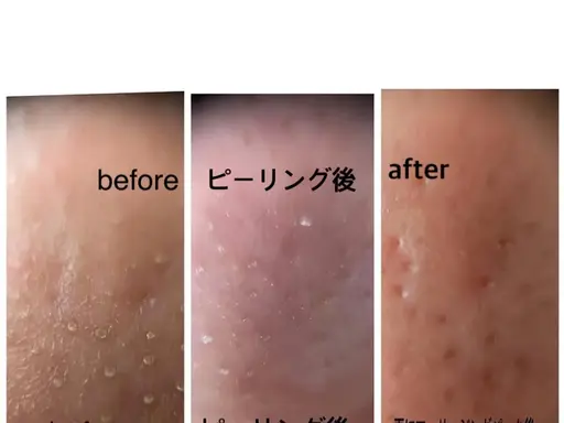 毛穴集中エステ