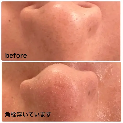 ７月限定メニュー✨【黒ずみ毛穴洗浄×全顔導入付き】角栓ポップアップ洗浄！黒ずみ◎ざらつき◎ツルツル肌へ🌿
