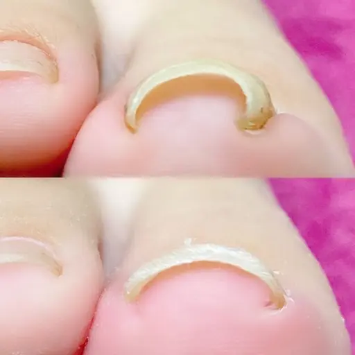 【フットネイル】巻き爪ケア