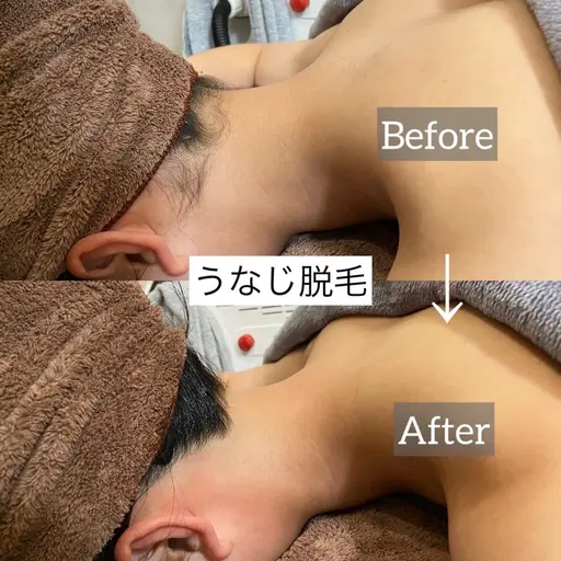 【うなじ背中脱毛🌷 】自分では見えない後ろ姿もキレイに✨アップヘアや後ろ姿に自信を🕊