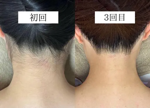 【成人式前撮り・イベント前に】うなじ+お顔脱毛シェービング・高保湿パック付き🪒