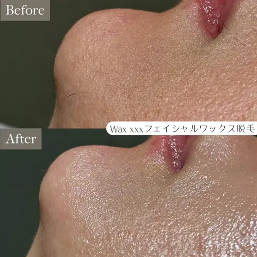 【化粧ノリUP】全顔産毛WAXでつるん肌♪wax脱毛→毛穴洗浄(鼻)→パック→お仕上げ¥17,600→¥7,700