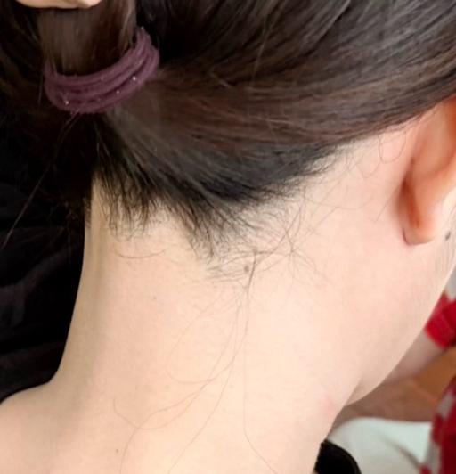 【アップスタイル美人へ♪】うなじ脱毛
