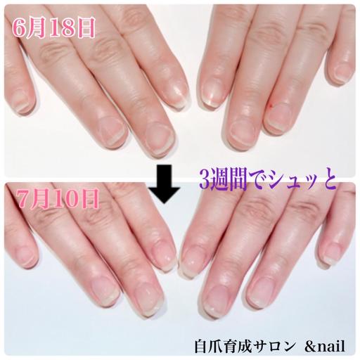 平らな爪、丸爪等でお悩みの方必見!圧倒的に症例数が多いので安心。自爪育成ジェル(ホームケア付き)初回1000円OFF。