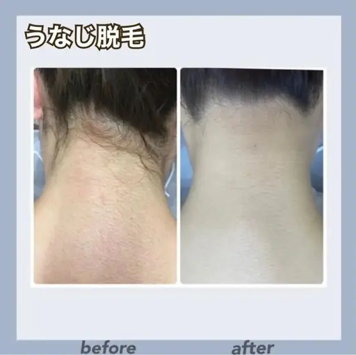 【うなじ脱毛】💖シェービング付き💖うなじ矯正脱毛✨意外と見られてる?後ろ姿美人に💆♀️