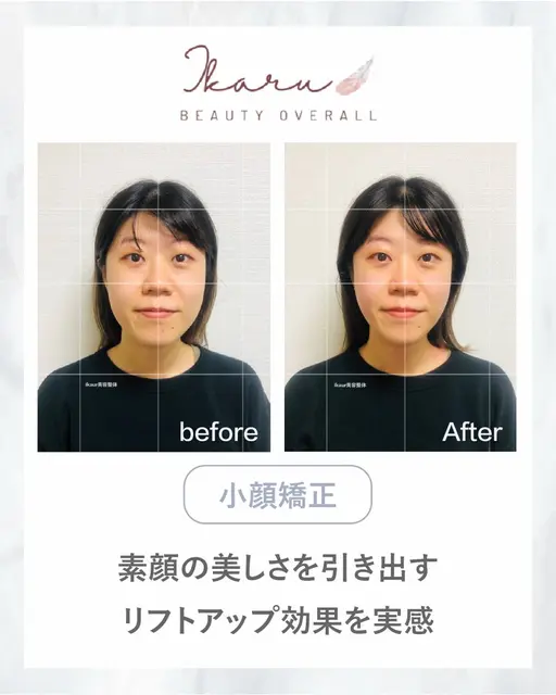 【期間限定モニター】小顔矯正20分｜フェイスラインをすっきりケア