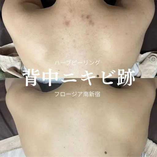 今月末まで限定《写真モニター》剥離ありExsハーブピーリング背中上or下90分19000→¥6900