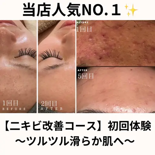 【本気集中】年齢毛穴ケア(剥離あり)通常18,000円