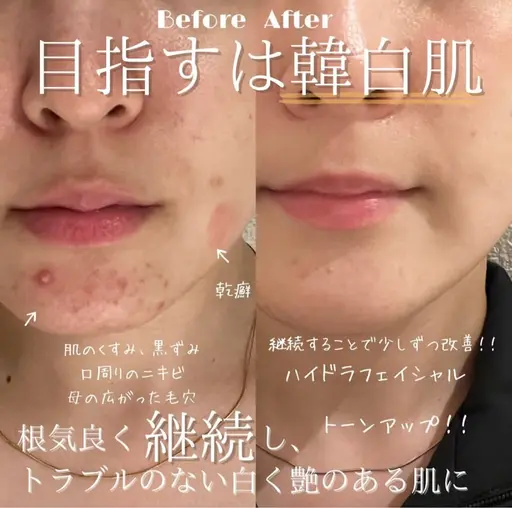 【本気で肌を治したい方限定‼️ごっそり毛穴撃退】毛穴洗浄