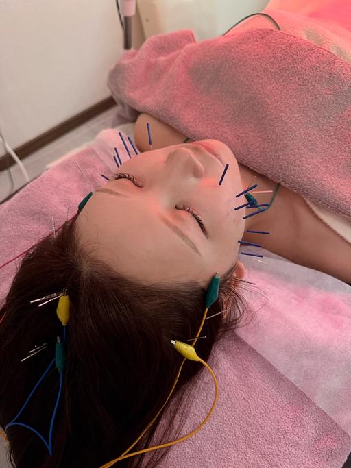 【 初回限定 】 電気を流す美容鍼 (首肩、お顔 、頭皮)+ ヘッドマッサージ付 ⚠︎︎電気有、無選べます!