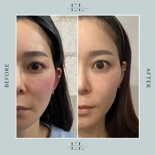ExoLift 《エクソリフト》　初回の方
