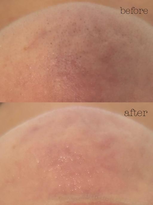 フェイシャルWax脱毛✨全顔