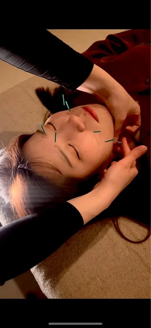 【美容鍼体験💆♀️】たるみ・むくみ・くすみをケア 60分 ¥4,980